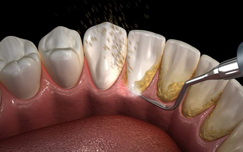 بلیچینگ دندان بهتر است یا جرم گیری دندان؟