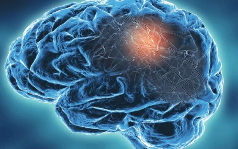 ابتلای شدید به کرونا مغز را ۲۰ سال پیر می‌کند