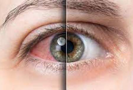 خشکی چشم؛ دلایل و راه‌های درمان