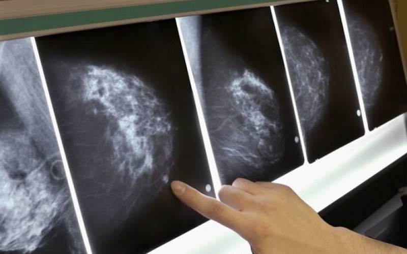 روند پیشرفت سرطان سینه درشب سریع تر است