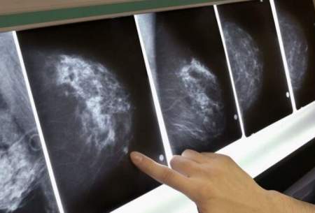 روند پیشرفت سرطان سینه درشب سریع تر است
