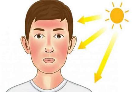 پیشگیری از آفتاب سوختگی با چند ماده غذایی