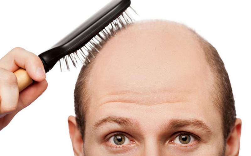عواملی که باعث ریزش موها می شود را بشناسیم