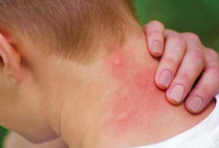 ۷ راه موثر برای درمان خانگی نیش پشه