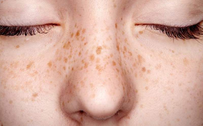 معرفی انواع روش‌های درمان لک‌های پوستی