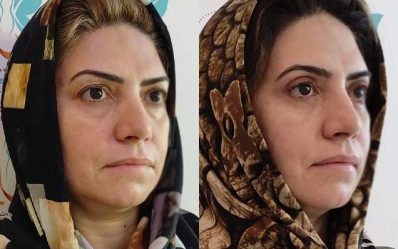 روش دایمی درمان افتادگی پلک در تهران