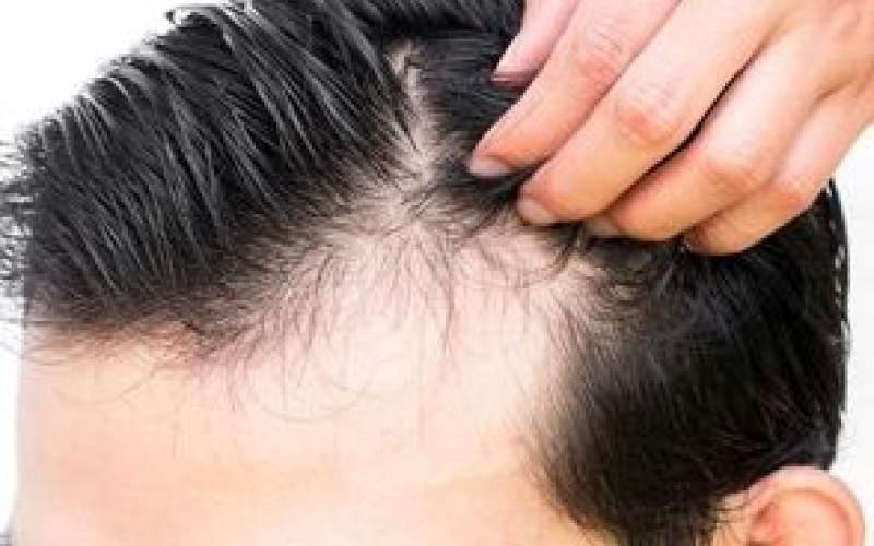 تاثیر استرس در بروز بیماری‌های پوست و مو