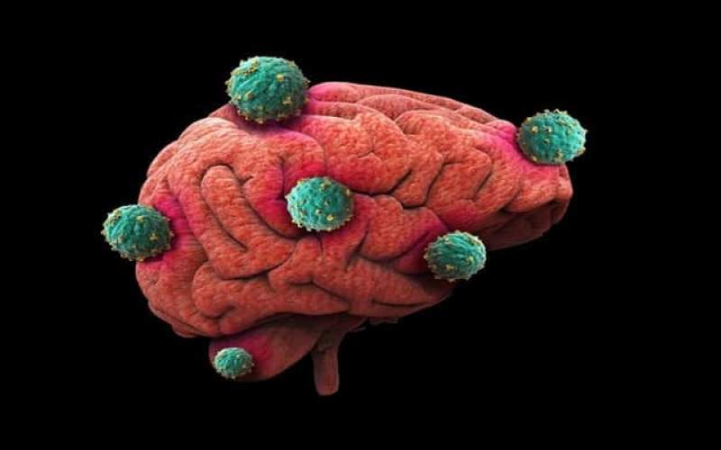 آنچه درباره تومور مغزی باید بدانید
