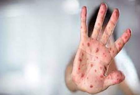 آخرین آمار شیوع بیماری سرخک در ایران