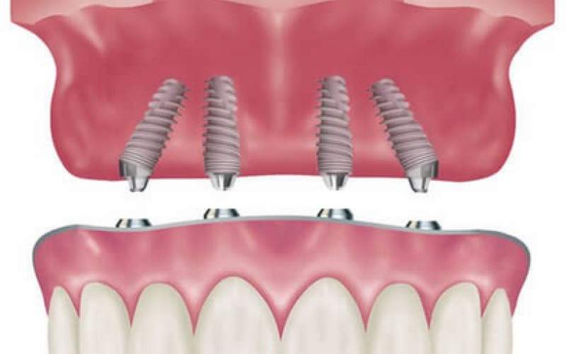دانستنی‌های مهم در خصوص ایمپلنت دندان