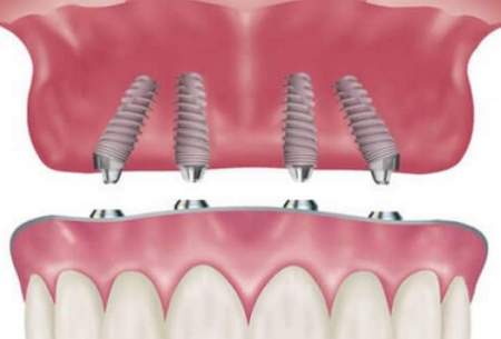 دانستنی‌های مهم در خصوص ایمپلنت دندان