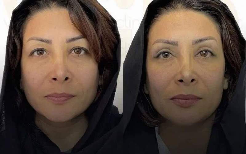 جدیدترین روش درمان افتادگی پلک در تهران