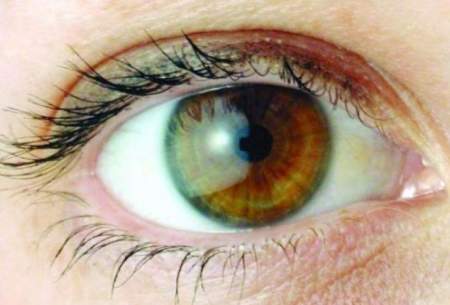 علائم و نحوه پیشگیری از آب سیاه چشم را بدانید