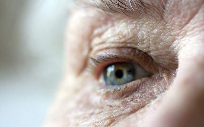 ارتباط چاقی با بیماری چشمی دژنراسیون ماکولا