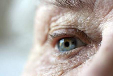 ارتباط چاقی با بیماری چشمی دژنراسیون ماکولا