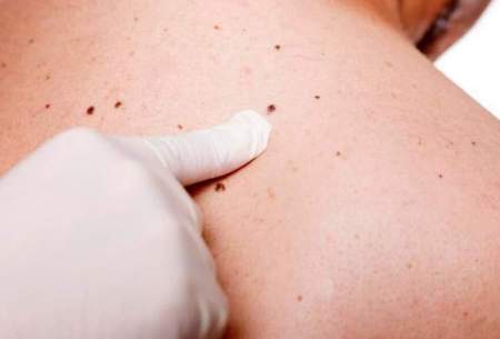 درمان سرطان پوست با یک روش جدید
