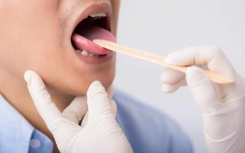 با علائم شایع سرطان دهان آشنا شوید