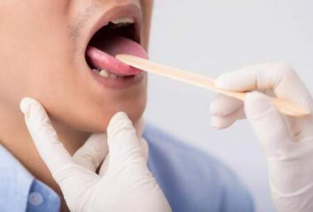 با علائم شایع سرطان دهان آشنا شوید