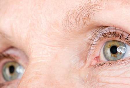 آیا بیماری آب سیاه  چشم قابل درمان است؟