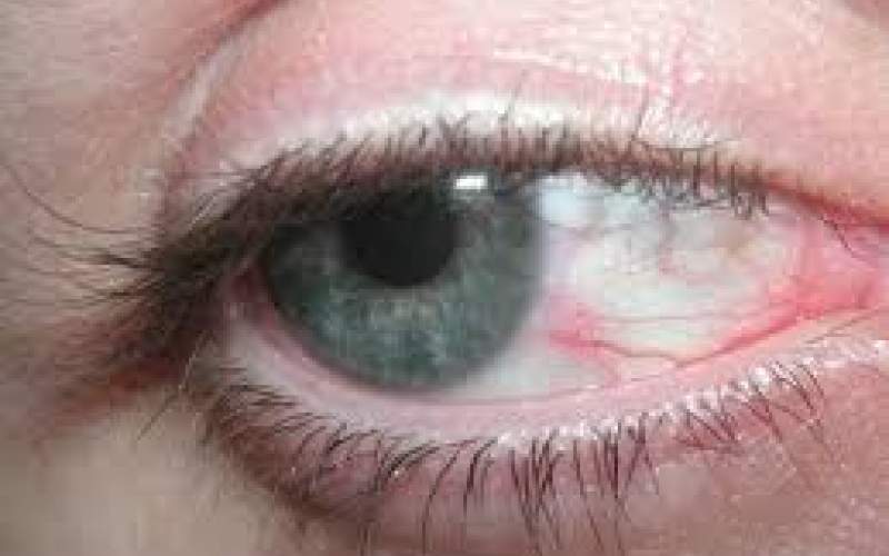 تشخیص این بیماری‌ها از روی چشم