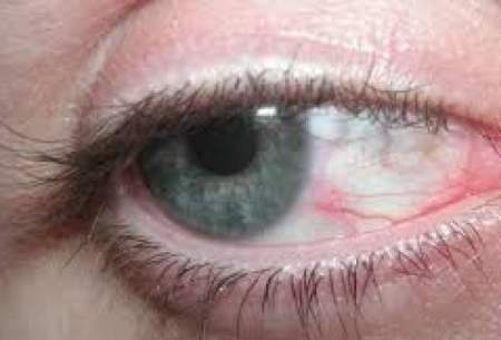 تشخیص این بیماری‌ها از روی چشم