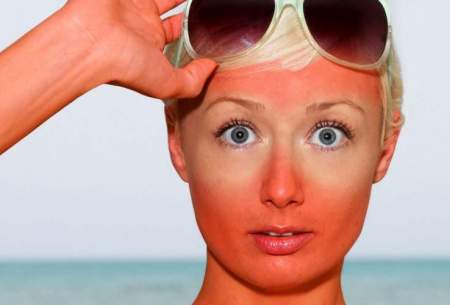 راهکارهای موثر برای درمان آفتاب‌ سوختگی