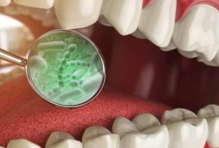 کشف‌مشارکت باکتریایی‌جدید در حفره‌های دندانی
