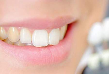 ۴روش خانگی برای رفع زردی دندان  را بشناسید