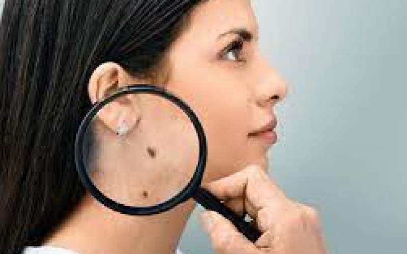 نخستین نشانه‌ها از سرطان پوست ‌را بشناسید