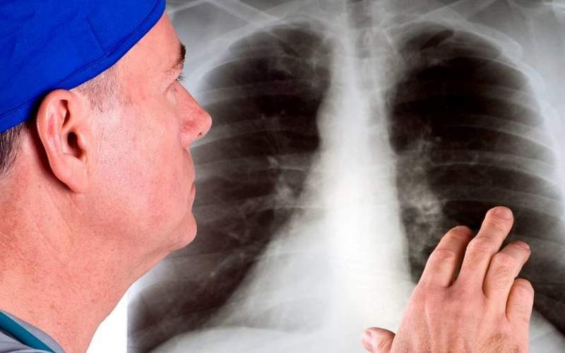 خطر ابتلا به سرطان ریه را کاهش دهید