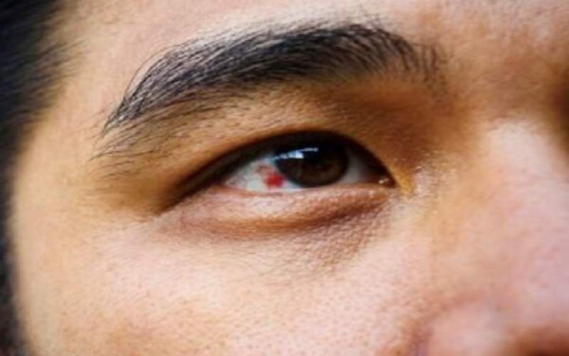 علت ایجاد لکه خون در چشم چیست؟