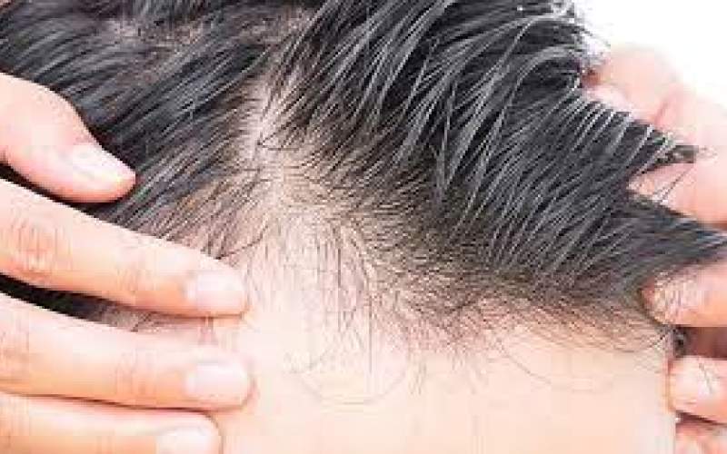 آیا می‌توان از ریزش مو جلوگیری کرد؟