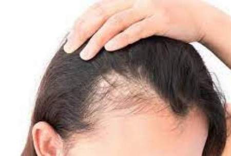 چگونه می‌توان از ریزش مو جلوگیری کرد؟