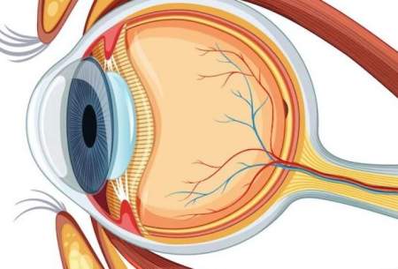 بیماری AMD ؛ مهم‌ترین علل کم بینایی