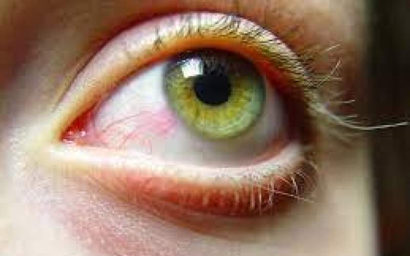آیا ممکن است داروها عامل خشکی چشم باشند؟