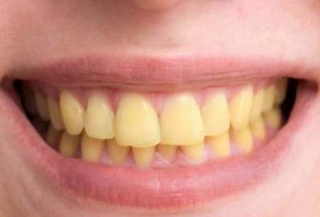 این عادت های غلط دندانتان را زرد می کند
