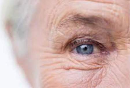 شایع ترین بیماری چشم در سالمندی را بشناسید