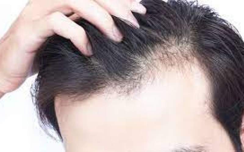 کلید درمان کامل طاسی و ریزش مو