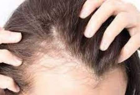 بیوتین چگونه به رشد مو کمک می‌کند؟