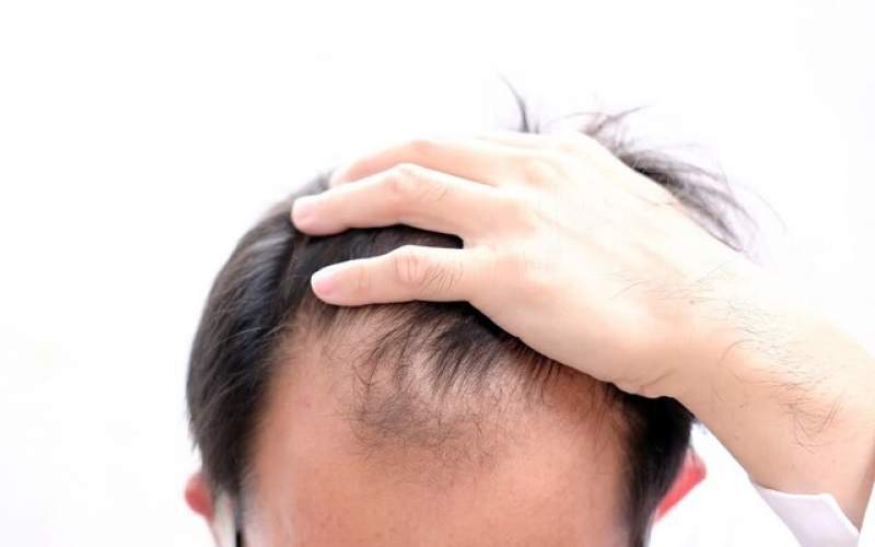 درمان ریزش مو با کراتین