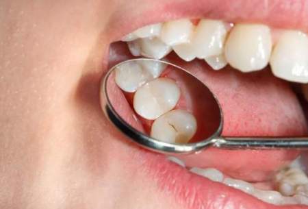 کاهش پوسیدگی‌های دندان با کنترل مصرف قند