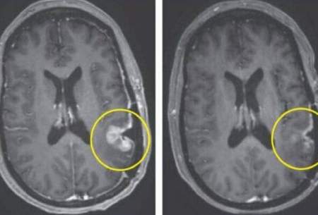 درمان باورنکردنی تومور مغزی تنها در ۵ روز