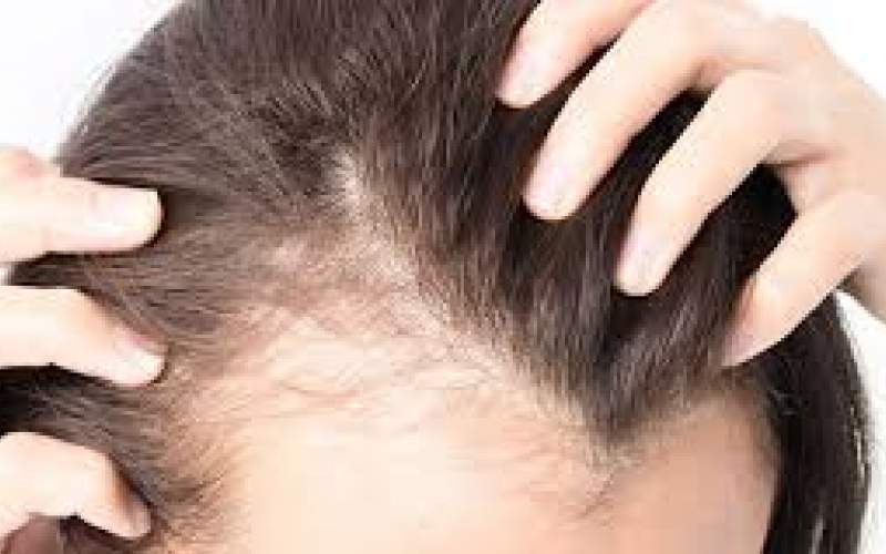 علت ریزش مو در زنان کمبود چه ویتامینی است