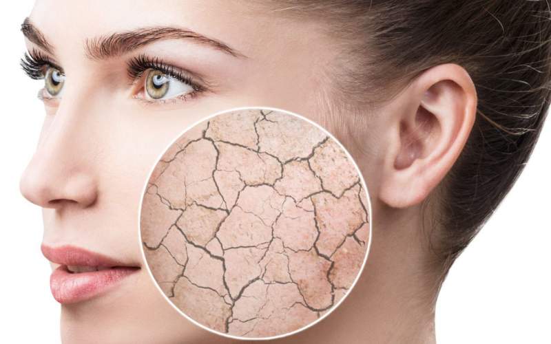 ۶ راهکار برای جلوگیری از خشکی پوست