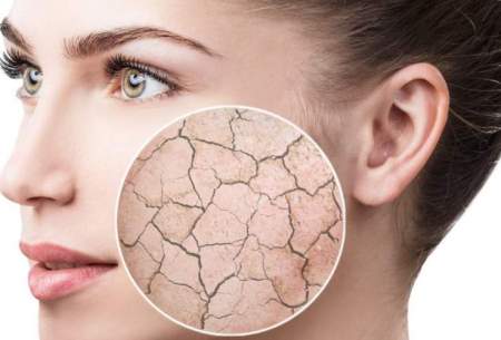 ۶ راهکار برای جلوگیری از خشکی پوست