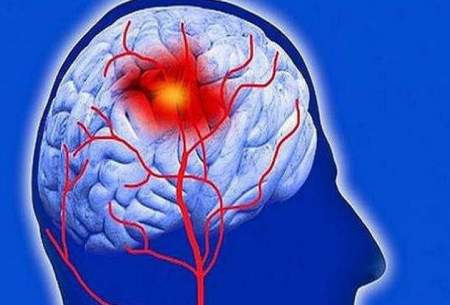 افزایش نرخ سکته مغزی در بین جوانان