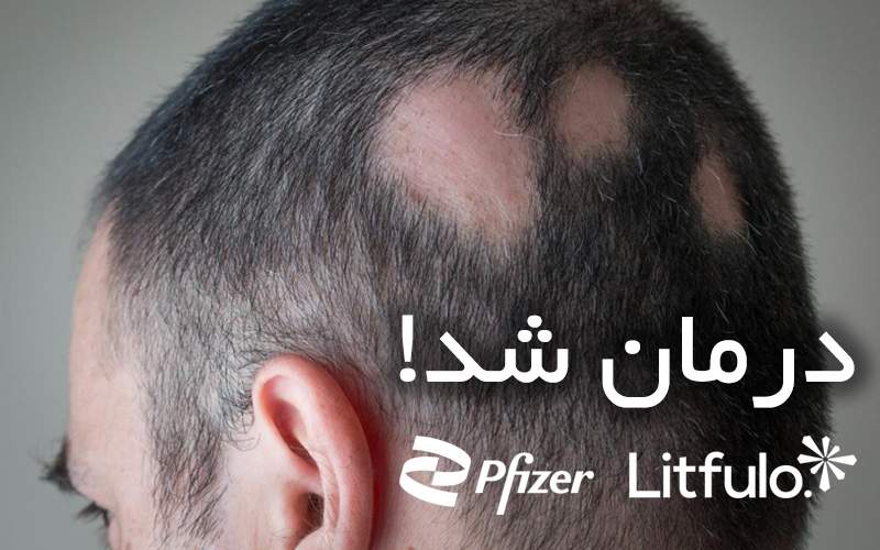 خبر امیدبخش برای درمان ریزش مو سکه‌ای، داروی لیتفولو تایید شد