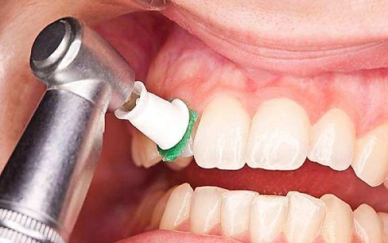 جرم‌گیری مینای دندانتان را تحلیل می‌برد؟