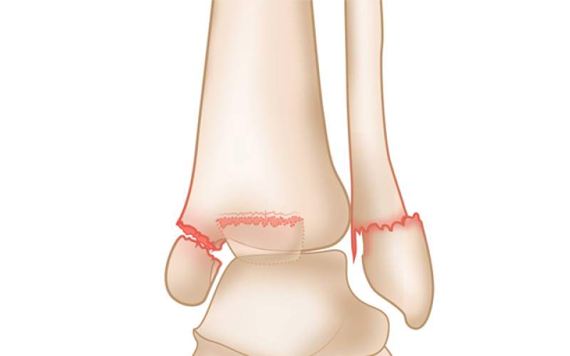 ترک خوردگی استخوان مچ پا