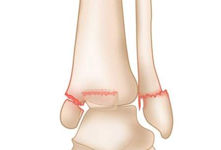 ترک خوردگی استخوان مچ پا